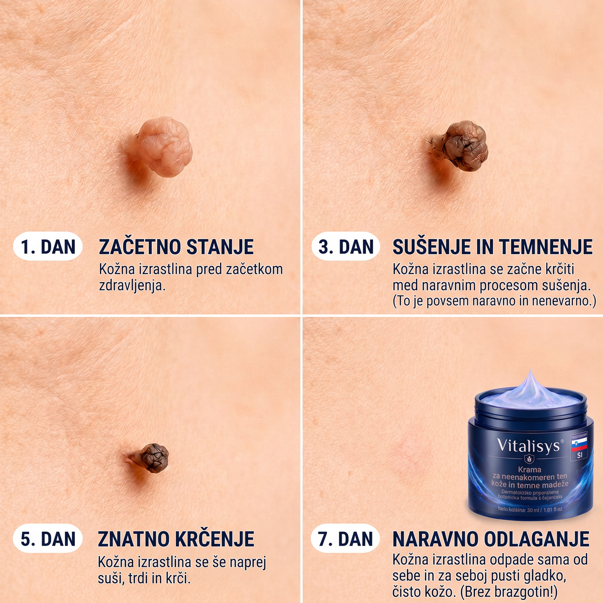 👩‍⚕️♥️ Vitalisys® 𝟕-𝐝𝐧𝐞𝐯𝐧𝐚 𝐤𝐫𝐞𝐦𝐚 𝐳𝐚 𝐨𝐝𝐬𝐭𝐫𝐚𝐧𝐣𝐞𝐯𝐚𝐧𝐣𝐞 𝐤𝐨ž𝐧𝐢𝐡 𝐢𝐳𝐫𝐚𝐬𝐭𝐤𝐨𝐯 𝐢𝐧 𝐦𝐚𝐝𝐞ž𝐞𝐯 (𝐍𝐞ž𝐧𝐚 𝐟𝐨𝐫𝐦𝐮𝐥𝐚 – 𝐛𝐫𝐞𝐳 𝐛𝐫𝐚𝐳𝐠𝐨𝐭𝐢𝐧) 👍🍈